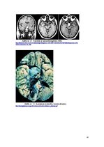 Referāts 'Hipofīzes audzēji', 28.