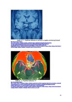 Referāts 'Hipofīzes audzēji', 29.