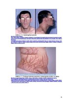 Referāts 'Hipofīzes audzēji', 30.