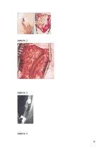 Referāts 'Pēc A.femoralis aneirismas protezēšanas iegūtās infekcijas pacientiem', 18.