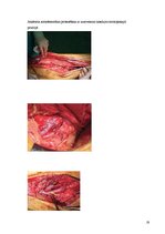 Referāts 'Pēc A.femoralis aneirismas protezēšanas iegūtās infekcijas pacientiem', 19.