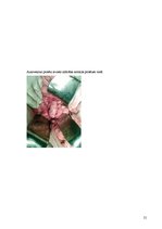 Referāts 'Pēc A.femoralis aneirismas protezēšanas iegūtās infekcijas pacientiem', 21.