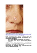 Referāts 'Bezpigmenta melanoma', 17.
