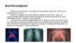 Prezentācija 'Bronhīts - elpošanas orgānu sistēmas slimība', 6.