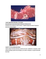 Konspekts 'Kaulu tuberkuloze', 12.