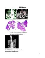 Konspekts 'Kaulu tuberkuloze', 18.