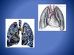 Prezentācija 'Elpošanas orgānu sistēma', 12.