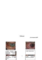 Referāts 'Acs traumas', 11.