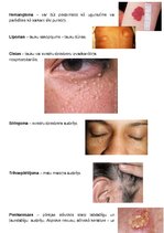 Konspekts 'Ādas audzēji', 4.