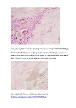 Prezentācija 'Podagras perēklis pēdas saistaudos', 6.