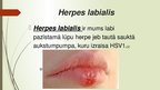 Prezentācija 'Herpes vīruss', 6.