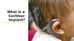 Prezentācija 'Cochlear Implant', 3.
