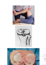 Referāts 'Fizioterapija un ārstēšanas iespējas pēc ceļa locītavas menisku traumām ', 3.