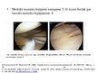 Referāts 'Fizioterapija un ārstēšanas iespējas pēc ceļa locītavas menisku traumām ', 41.