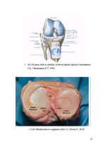 Referāts 'Fizioterapija un ārstēšanas iespējas pēc ceļa locītavas menisku traumām ', 74.