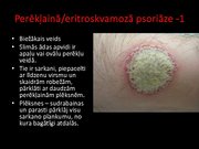 Prezentācija 'Psoriāze', 9.