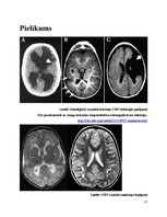 Referāts 'Citomegalovīrusa infekcija jaundzimušajiem', 12.