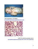 Referāts 'Citomegalovīrusa infekcija jaundzimušajiem', 13.