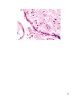 Referāts 'Citomegalovīrusa infekcija jaundzimušajiem', 15.