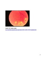 Referāts 'Citomegalovīrusa infekcija jaundzimušajiem', 17.