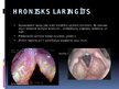 Prezentācija 'Akūti un hroniski laringīti', 11.