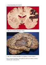 Konspekts 'Galvas smadzeņu hemorāģisks infarkts', 4.