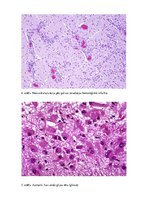 Konspekts 'Galvas smadzeņu hemorāģisks infarkts', 6.