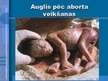 Prezentācija 'Aborta definīcija un abortu veidi', 4.