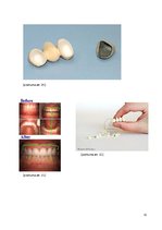 Referāts 'Zobu protezēšana', 32.