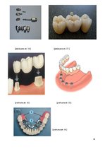 Referāts 'Zobu protezēšana', 34.