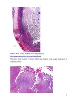 Referāts 'Hronisks apendicīts', 7.