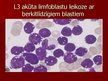 Prezentācija 'Akūta leikoze', 16.