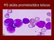 Prezentācija 'Akūta leikoze', 22.
