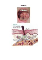 Konspekts 'Iekaisums un tā veidi', 10.
