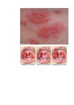 Konspekts 'Iekaisums un tā veidi', 11.