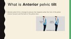 Prezentācija 'Anterior Pelvic Tilt', 2.