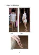 Referāts 'Artrogripozes klīniskās izpausmes, sekas, ārstēšana un rehabilitācijas iespējas', 38.