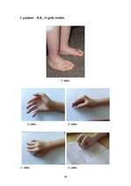 Referāts 'Artrogripozes klīniskās izpausmes, sekas, ārstēšana un rehabilitācijas iespējas', 39.