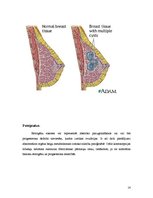 Konspekts 'Fibroadenoma. Fibrocistiska krūts slimība', 14.