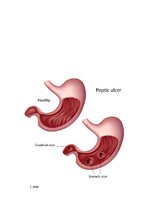 Konspekts 'Duodēna čūla un psihosomatika', 2.