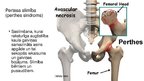 Prezentācija 'Pertesa slimība', 2.