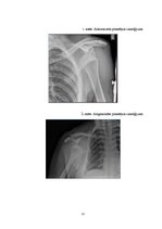 Referāts 'Hilla-Saksa lūzums pie pleca priekšējā izmežģījuma', 12.