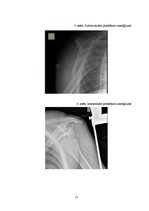Referāts 'Hilla-Saksa lūzums pie pleca priekšējā izmežģījuma', 13.