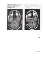Referāts 'Multiplās sklerozes diagnostikas un ārstēšanas iespējas Latvijā', 40.