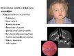 Prezentācija 'Ģenētiskie sindromi, kuriem raksturīgi kurlums un auss anomālijas', 10.