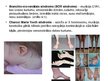 Prezentācija 'Ģenētiskie sindromi, kuriem raksturīgi kurlums un auss anomālijas', 15.