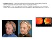 Prezentācija 'Ģenētiskie sindromi, kuriem raksturīgi kurlums un auss anomālijas', 16.
