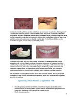 Konspekts 'Izņemamās zobu protēzes balstītas, uz implantiem', 13.
