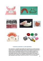 Konspekts 'Izņemamās zobu protēzes balstītas, uz implantiem', 19.