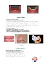 Konspekts 'Izņemamās zobu protēzes balstītas, uz implantiem', 20.